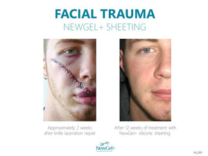 NewGel+ Sheet