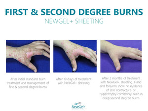 NewGel+ Sheet